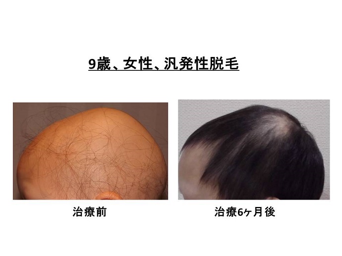 円形脱毛症　病院""